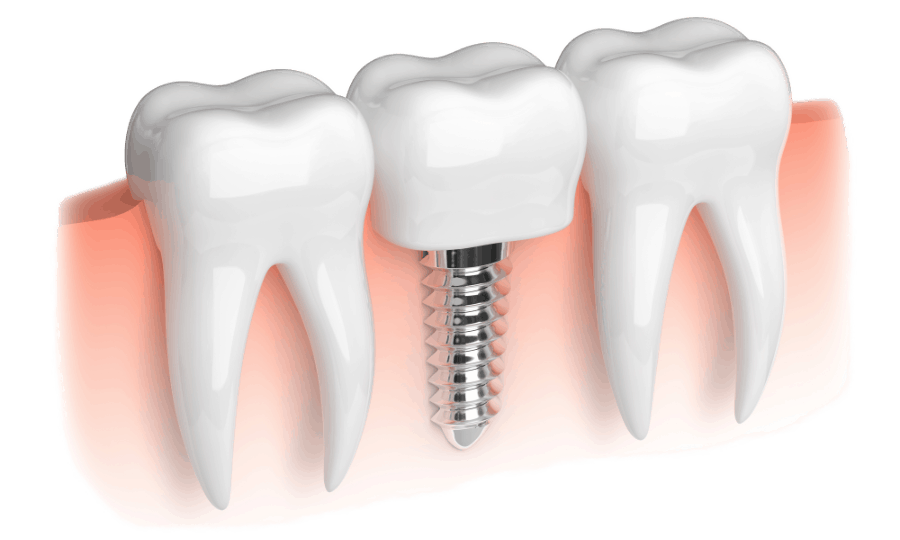 Realistic View of a Dental Implant