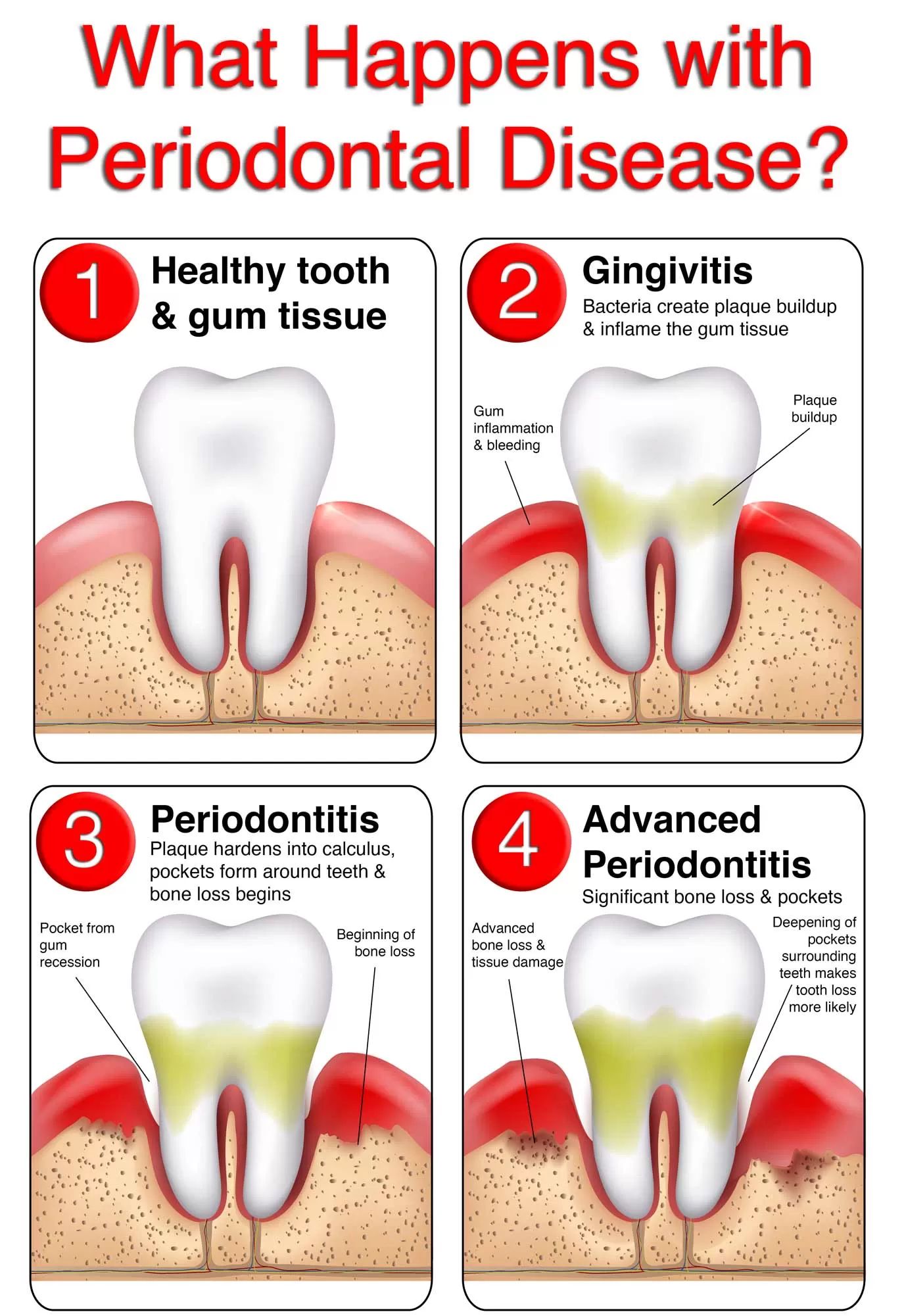 Gum Disease Symptoms And Treatment AllSmiles Dental Care