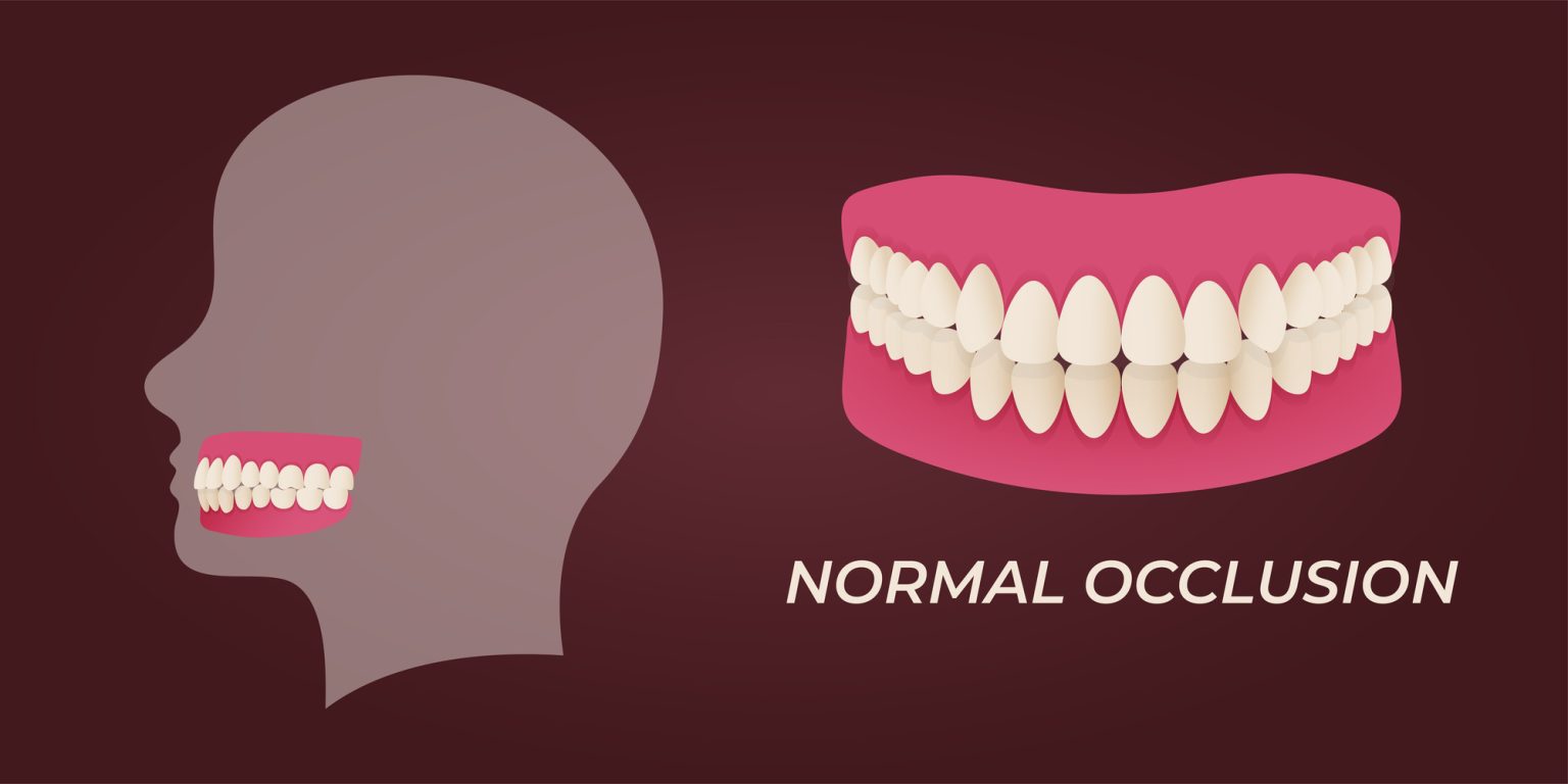 7 Types Of Malocclusion Allsmiles Dental Care