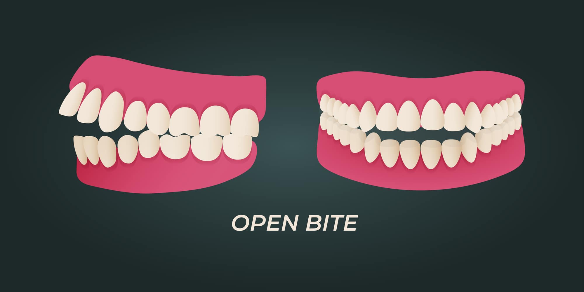 7 Types Of Malocclusion Allsmiles Dental Care